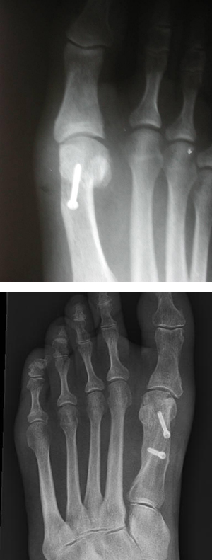 Hallux Valgus Correction Bunion Surgery - Dr Greg Sterling