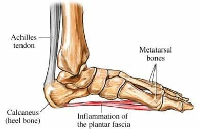 Surgery for Plantar Fasciitis - Dr Greg Sterling