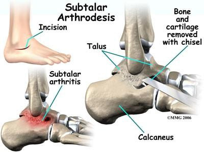 subtalar joint