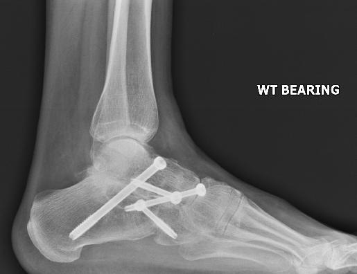What do you do in the hospital after an arthrodesis operation to fuse the ankle?