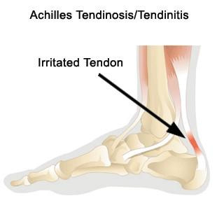 Microsoft Word - surgery_achilles_tendon_debridement-3.rtf