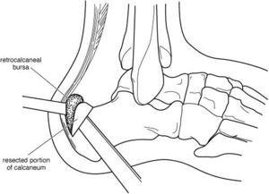 Microsoft Word - surgery_achilles_tendon_debridement-3.rtf