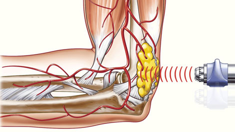 RPW shockwave therapy