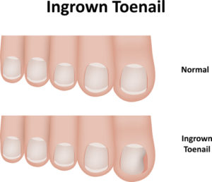 Illustration of ingrown toenail vs. normal 