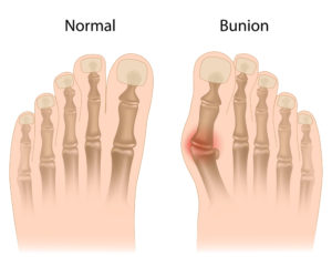 Picture of normal foot vs. bunion