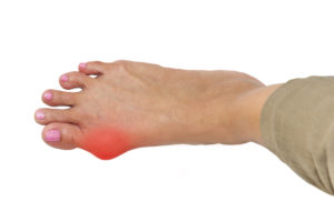 foot with bunion highlighted