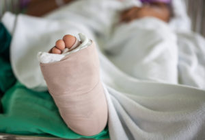 resting bandaged foot after bunion removal