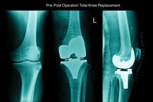 total knee replacement xray