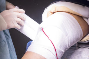 Knee bandaged post arthroscopy